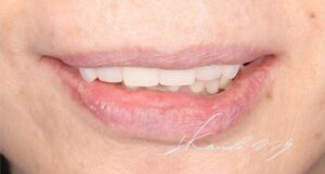 60代で総入れ歯を回避できた症例の仮歯と仮義歯の状態の見た目