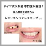 レジリエンツテレスコープとは|メリット・寿命・費用・症例を専門医が解説