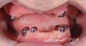 60代男性でインプラントを選ばなかった症例の治療後のドイツ式入れ歯テレスコープ義歯の内冠の状態