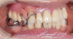 60代女性|全て保険内治療で食事ができずお困りの状態