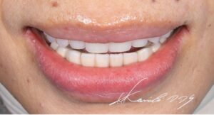 60代女性の治療後|ドイツ式入れ歯(テレスコープ義歯)で治療した見た目