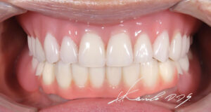 60代女性の治療後|ドイツ式入れ歯(テレスコープ義歯)で治療した状態