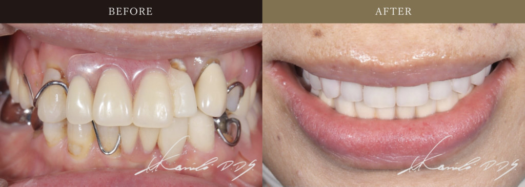 歯がボロボロの方の症例集