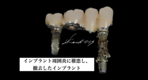 インプラント周囲炎に罹患し、撤去したインプラント